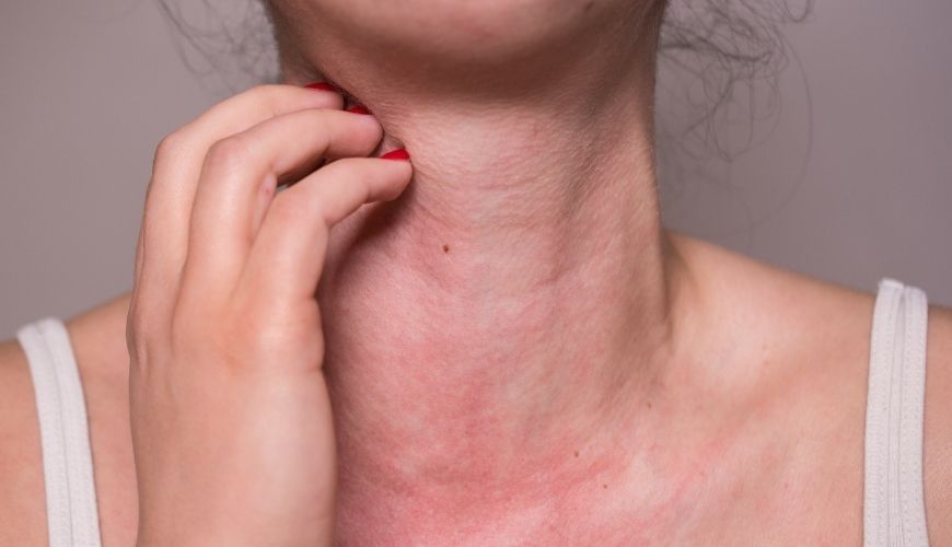 Al·lèrgia al coll d'una dona