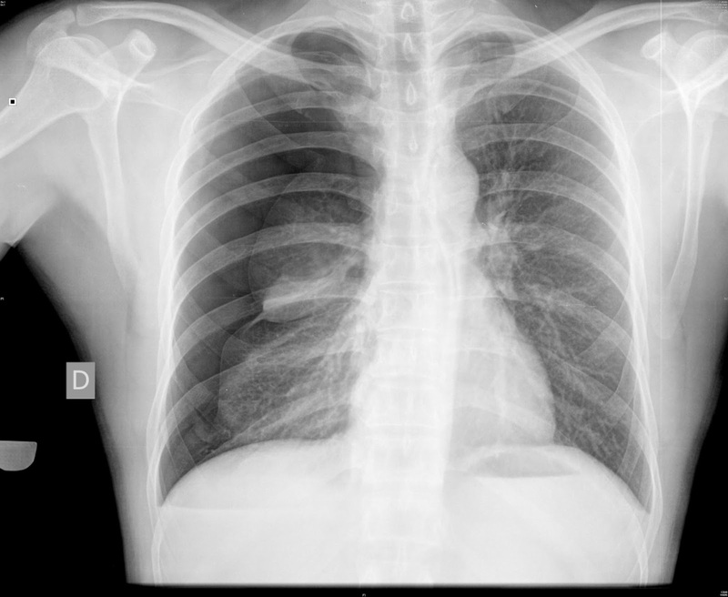 Cirurgia Toracica i Trasplatament