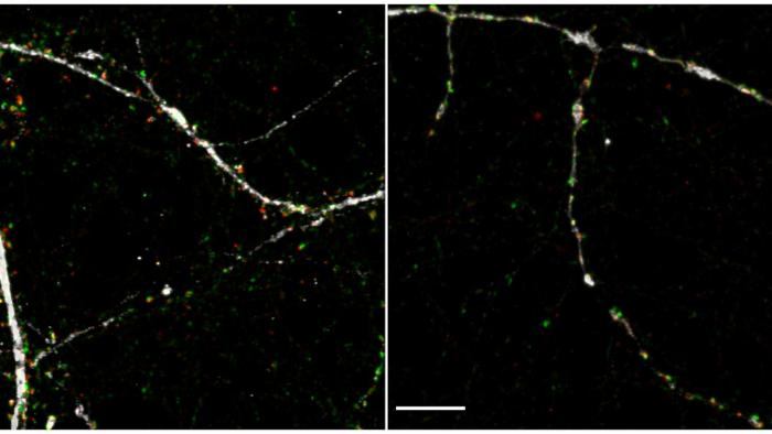 Astrocids esclerosi múltiple