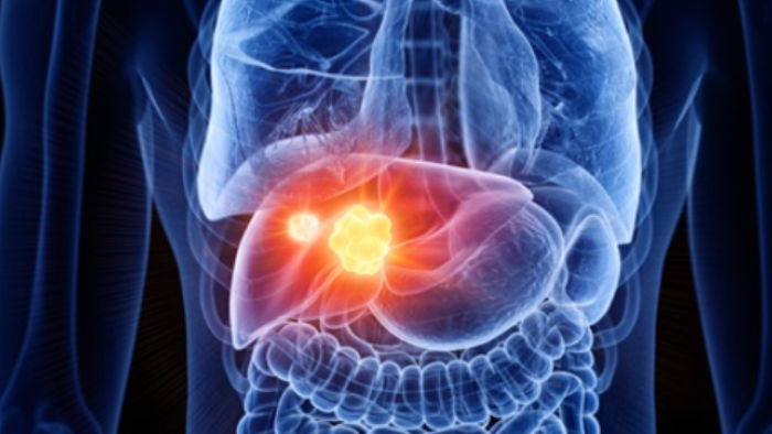 Comite Tumors Hepatics