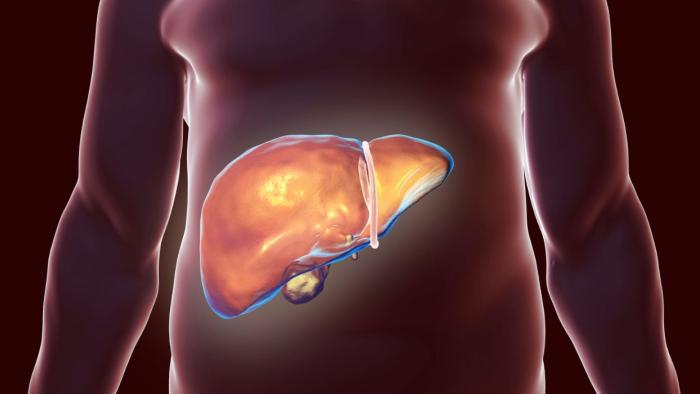Fetge hepatocarcinoma