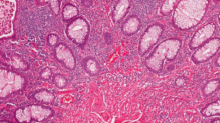 Biòpsia de budell prim a Vall d'Hebron