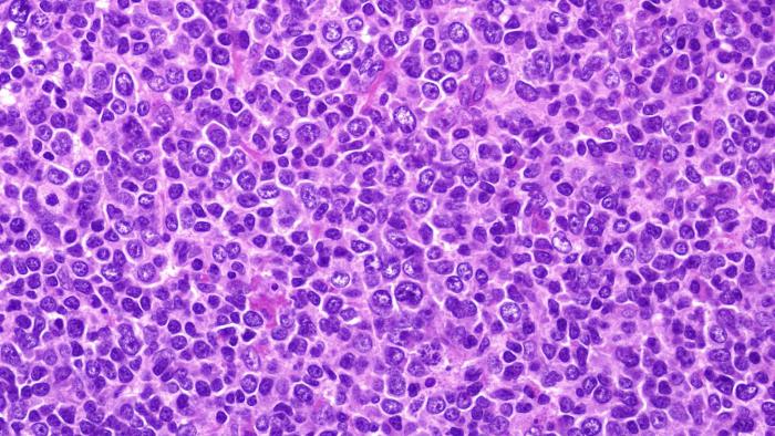 Aspiració medul·lar òssea a Vall d'Hebron