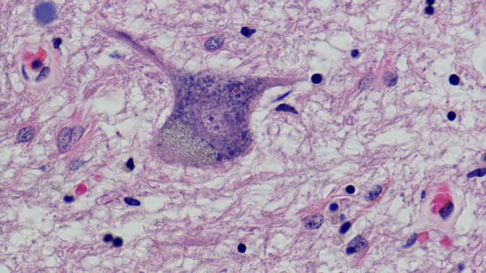 Esclerosis Lateral Amiotrófica (ELA)  a Vall d'Hebron