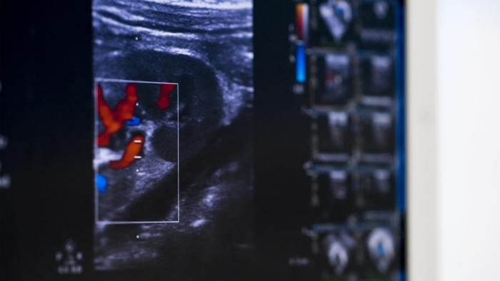 Estenosi aòrtica a Vall Hebron