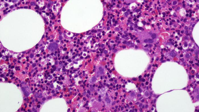 Policitemia vera a Vall d'Hebron