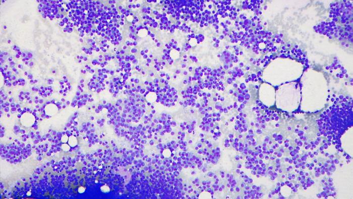 Mieloma Múltiple Vall d'Hebron