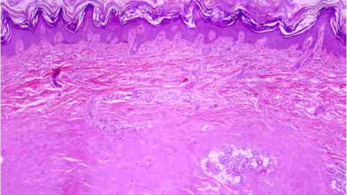 Esclerodèmia a Vall d'Hebron