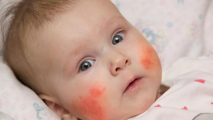 Síndrome de Kawasaky Vall d´Hebron