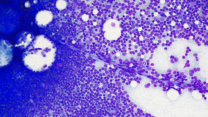 Limfoma folicular Vall d'Hebron