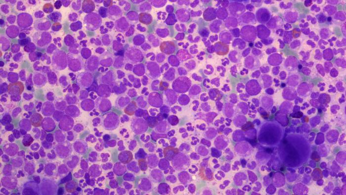 leucèmia crònica Vall d'Hebron