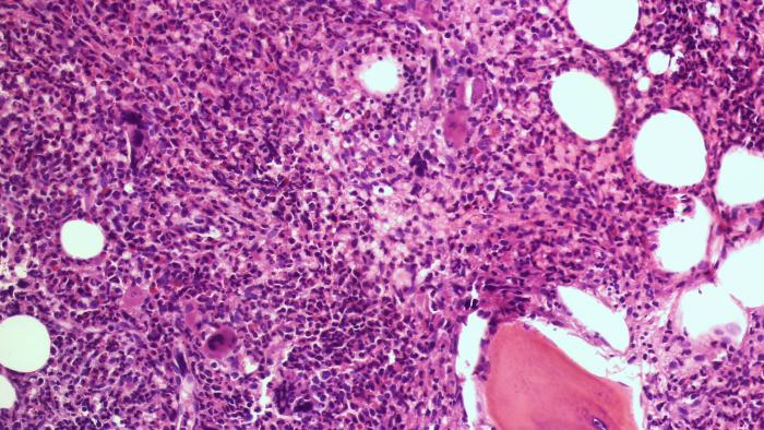 Mielofibrosi Vall d'Hebron