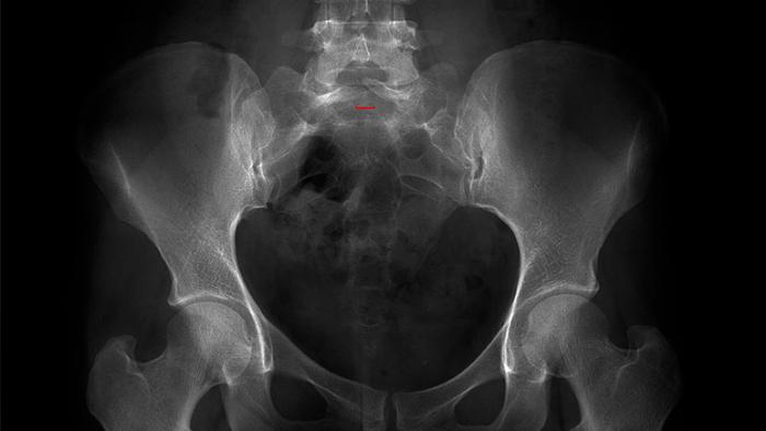 Espina bífida Vall dHebron