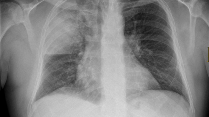 Pneumònia Vall d'Hebron.png