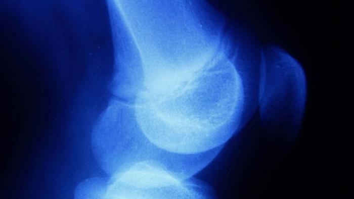 Sarcoma d'Ewing en els infants a Vall d'Hebron