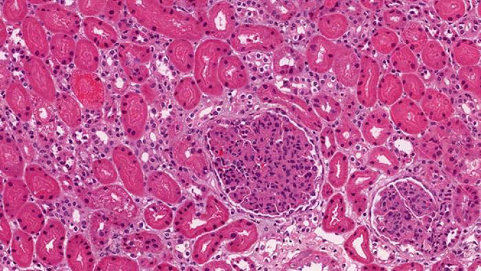 biòpsia renal Vall d'Hebron