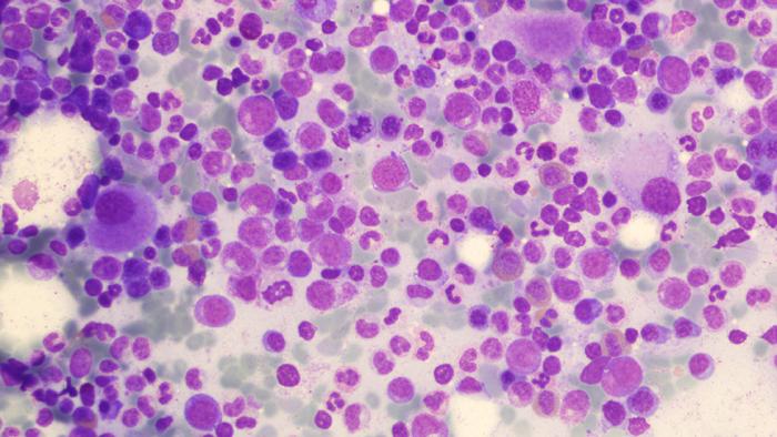 Síndromes mielodisplàsiques a Vall d'Hebron