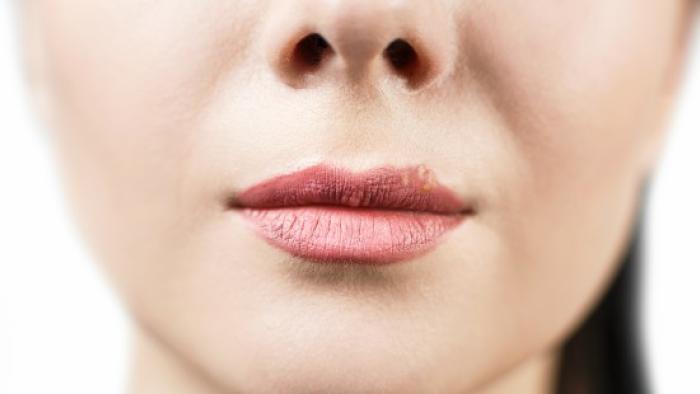 Tractament de l'herpes simple a Vall d'Hebron