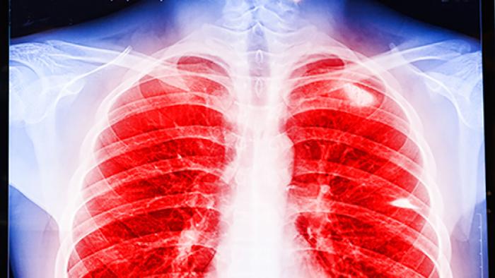 Trasplantament pulmonar a Vall d'Hebron