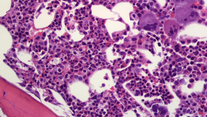 Trombocitèmia essencial a Vall d'Hebron