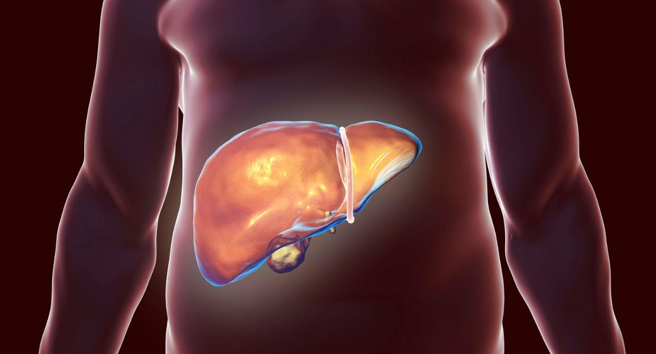 Fetge hepatocarcinoma