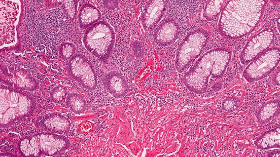 Biòpsia de budell prim a Vall d'Hebron