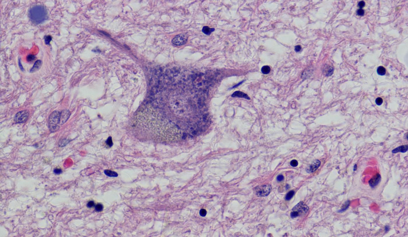 Esclerosis Lateral Amiotrófica (ELA)  a Vall d'Hebron