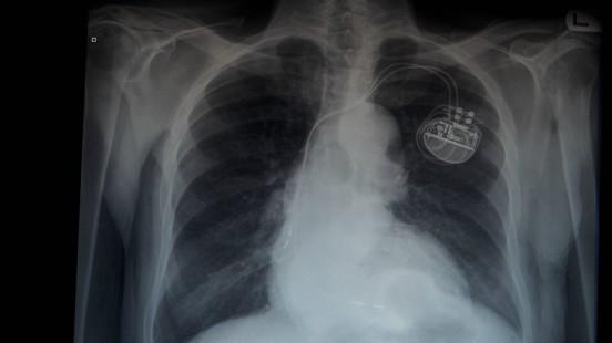Implantació del marcapassos a Vall d'Hebron