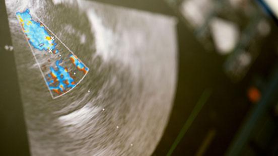 Lesions valvulars: estenosi pulmonar a Vall d'Hebron