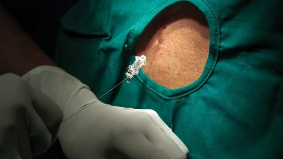 Punció lumbar a Vall d'Hebron