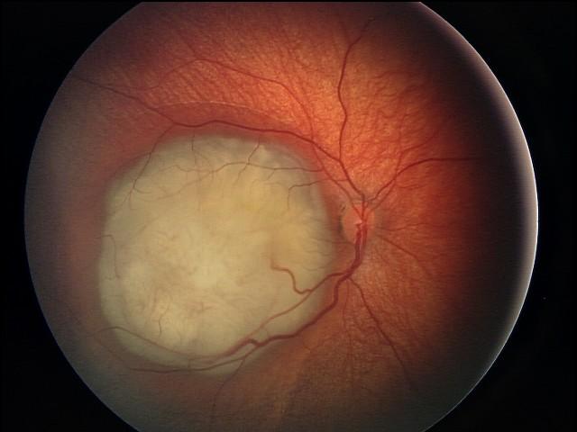 Retinoblastoma