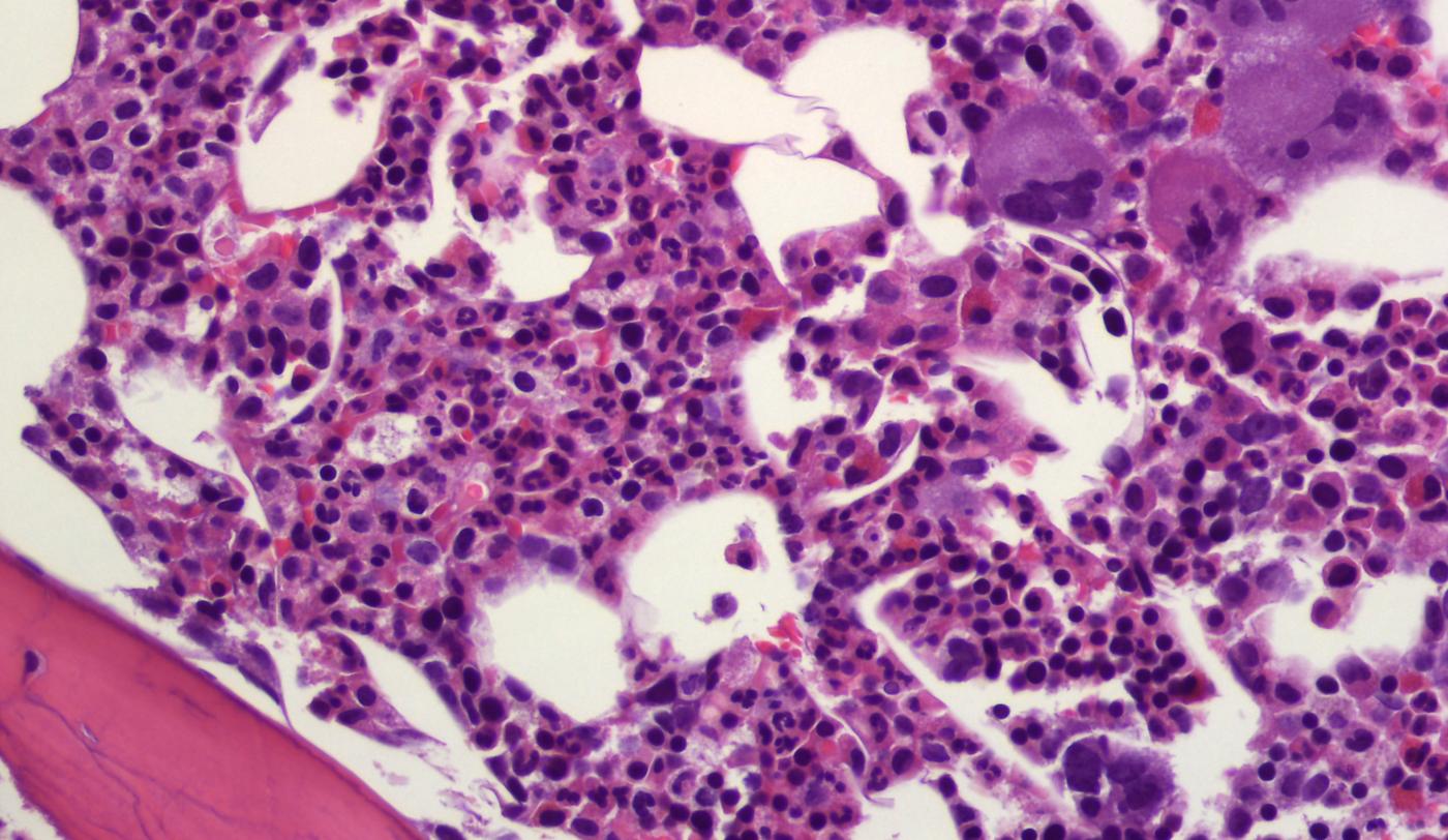 Trombocitèmia essencial a Vall d'Hebron